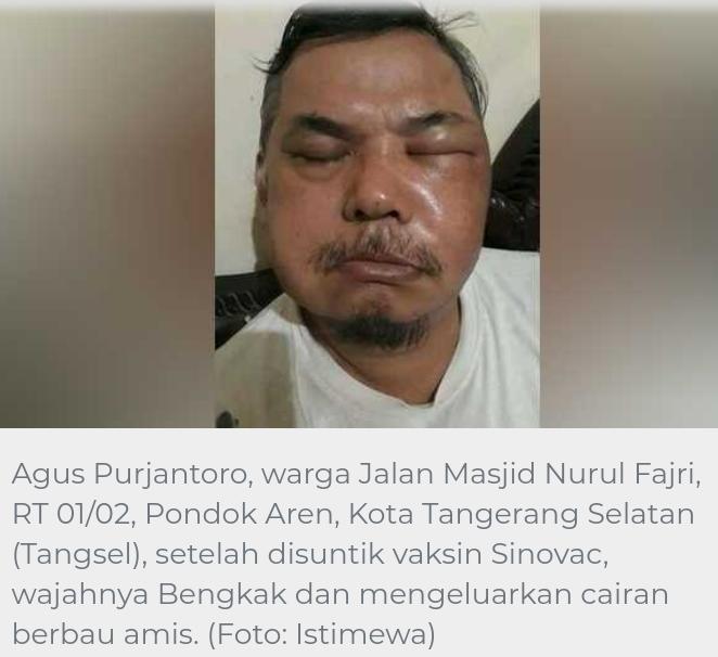 Wajah Bengkak Keluarkan Cairan Berbau Amis, Pasca Disuntik Vaksin Sinovac