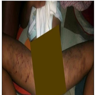 RATAPAN IBU TIRI, SEORANG BALITA BADANNYA PENUH DI CUBIT DAN SUNDUTAN ROKOK