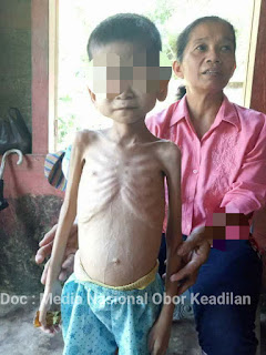 PENDERITA GIZI BURUK Di NIAS JADI PERHATIAN DINKES KABUPATEN NIAS 
