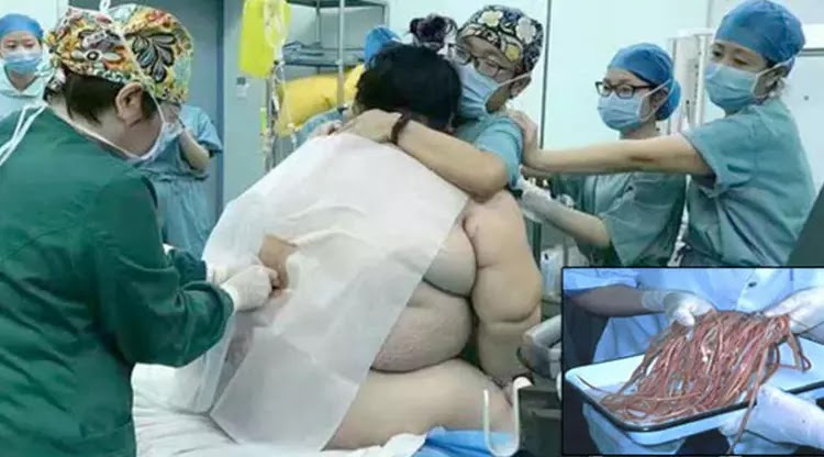 Cacing Pita 7,7 Meter Bersarang di Tubuh, Wanita Ini Dikira Hamil