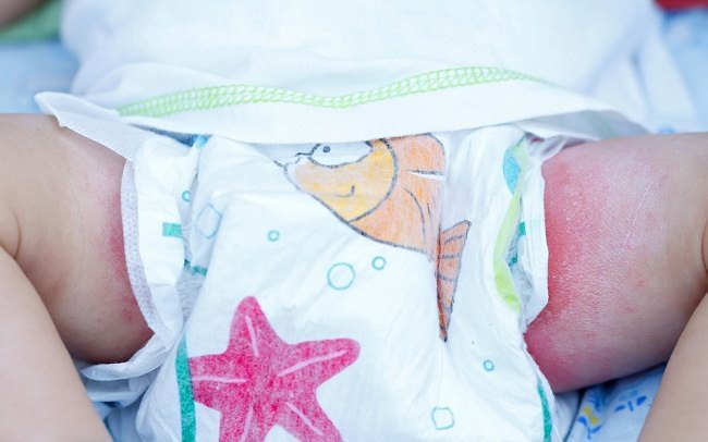 Ruam Popok Adalah Iritasi Pada Kulit Bayi di Area Tertutup, Ini Penyebabnya  