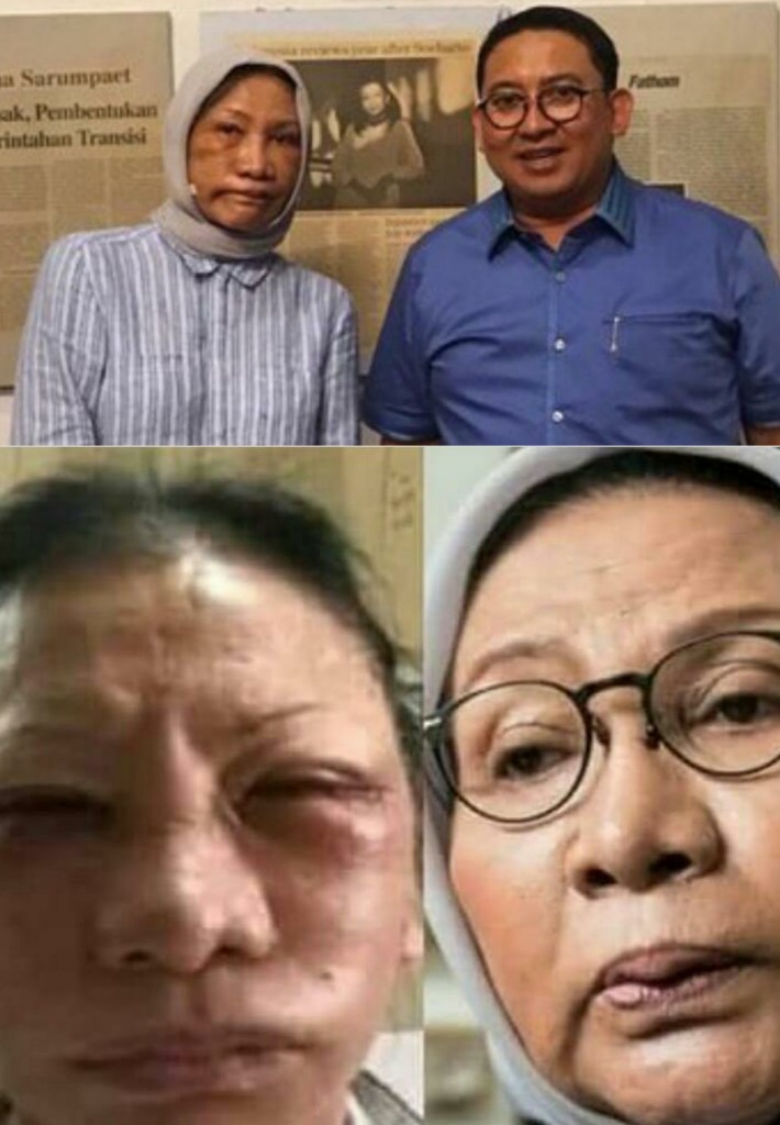 Kabar Hoax Ratna Sarumpaet Dianiaya Ternyata Operasi Plastik Di Kawasan Menteng Jakarta