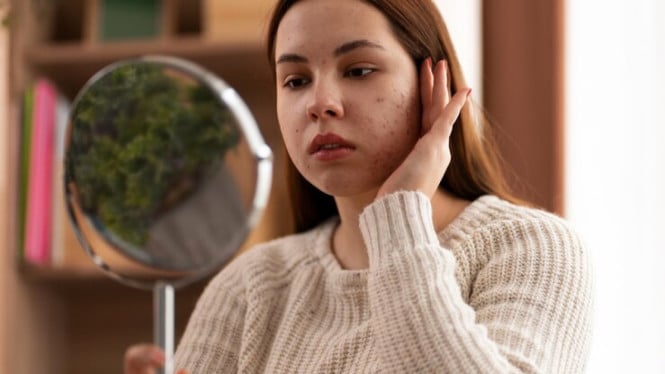 Mitos Sunscreen Picu Jerawat: Dermatolog Jelaskan Pentingnya Perlindungan UV untuk Kulit Bermasalah